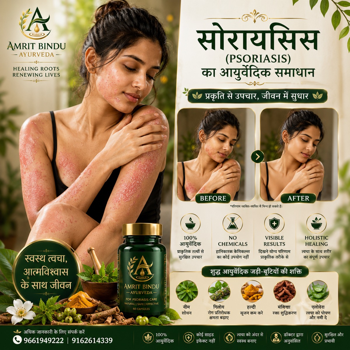 सोराइसिस आयुर्वेदिक समाधान