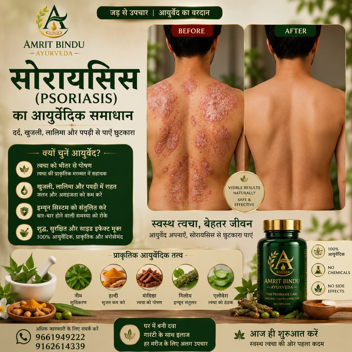 सोराइसिस उपचार — पहले और बाद में